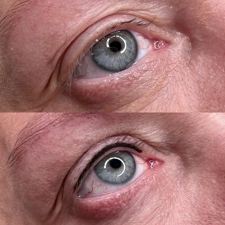 A before and after photo of the eyes of an older man.