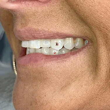 A woman with braces on her teeth and smiling.