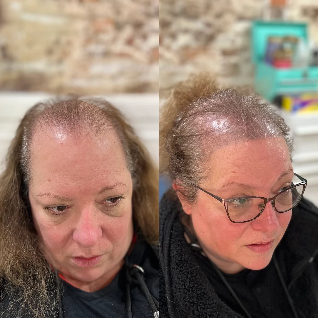 A before and after picture of a woman with hair loss.