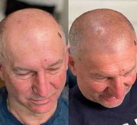 A man with bald head and hair loss.