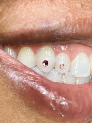 A close up of the teeth with a red diamond on it