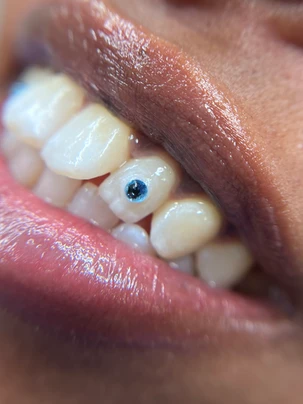 A close up of the teeth with one blue dot on it.