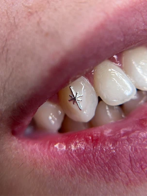 A close up of the teeth with a spider on them