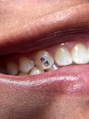 A close up of the teeth with colored gems on them