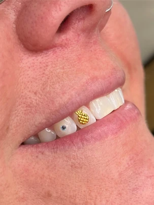 A close up of a person 's teeth with a yellow and blue sticker on them.