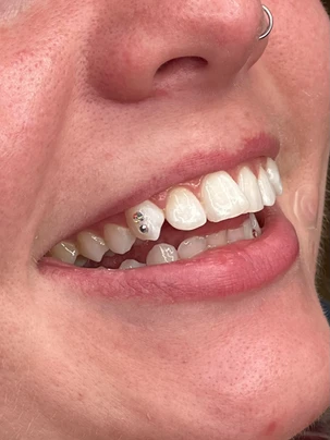 A woman with white teeth and missing tooth.