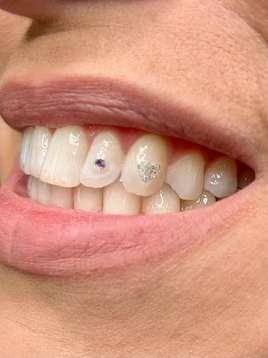A close up of the teeth with an individual tooth mark on it.