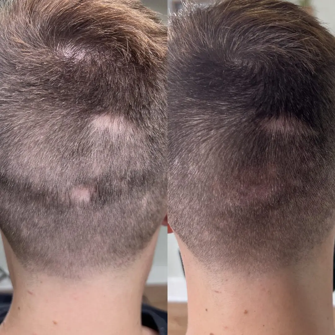 A man with hair loss and the back of his head